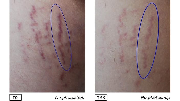 estrias antes y despues de usar balsamo antiestrias