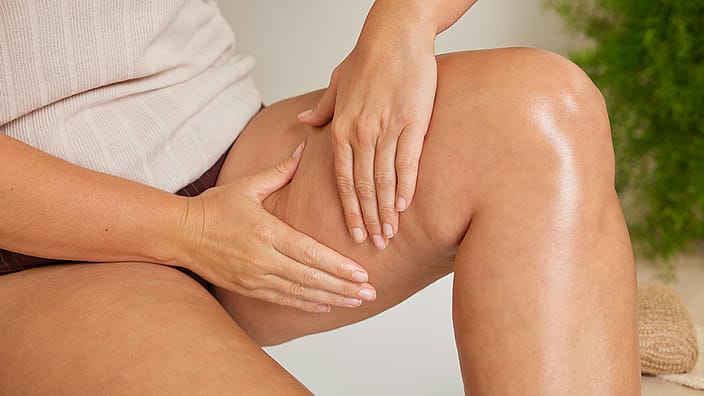 celulitis 4